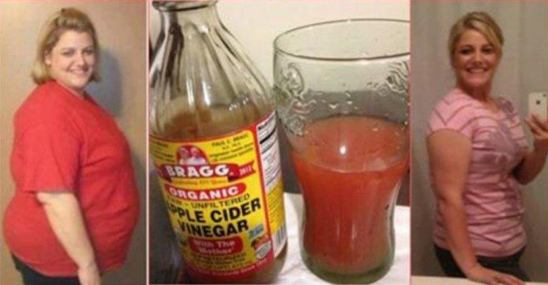 Apple Cider Vinegar Weight Loss Results
 How To Lose Stomach Fat Overnight literally with this so